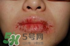 嘴唇干燥是什么原因？嘴唇干裂脫皮怎么辦？