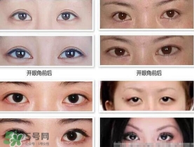哪些人需要開眼角？需要開眼角的眼睛圖片
