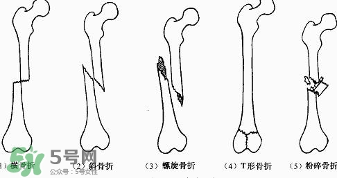 骨折吃什么好得快？骨折后注意事項