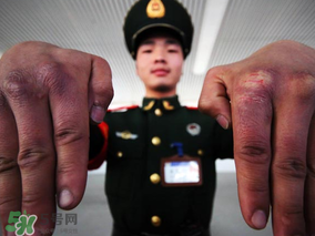 三月份還長(zhǎng)凍瘡嗎？三月份凍瘡沒好怎么辦？