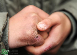 三月份還長(zhǎng)凍瘡嗎？三月份凍瘡沒好怎么辦？