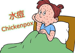 水痘是天花嗎？水痘是不是天花？