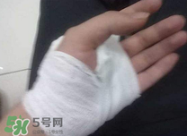 傷口化膿怎么處理？傷口化膿用什么藥好？