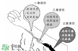 燙傷起泡要挑破嗎？燙傷起泡怎么處理？