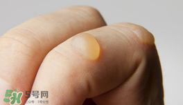 燙傷起泡要挑破嗎？燙傷起泡怎么處理？