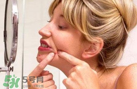 下巴長痘怎么辦？下巴長痘怎么調理