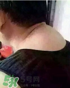 刮痧之后可以艾灸嗎？刮痧之后可不可以艾灸