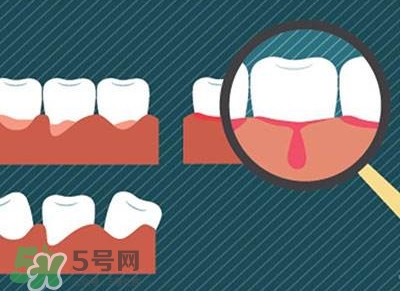 牙齦出血是什么原因？牙齦出血怎么回事