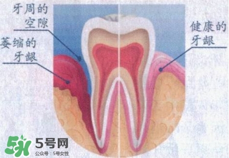 牙齦萎縮怎么辦？牙齦萎縮癥狀