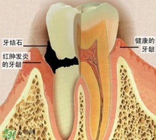 牙結(jié)石是什么？牙結(jié)石圖片