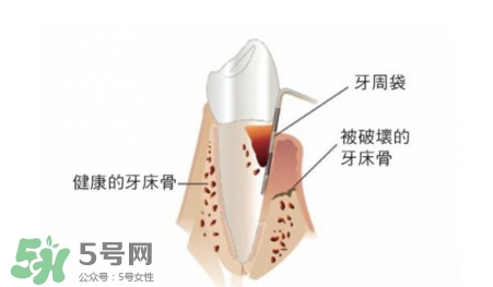 牙周炎怎么治療？牙周炎怎么治好