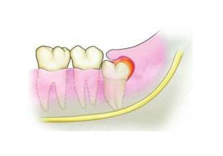 長智齒需要拔掉嗎？長了智齒一定要拔掉嗎