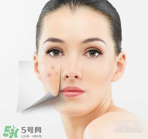黑色痘印多久會消失？黑色痘印消失時間