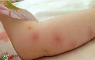 嬰兒蚊子咬了怎么消腫？嬰兒蚊子咬了怎么消腫止癢最快？