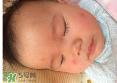 嬰兒蚊子咬了怎么消腫？嬰兒蚊子咬了怎么消腫止癢最快？