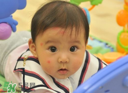 嬰兒被蚊子咬了如何去紅點(diǎn)？被蚊子咬后紅點(diǎn)如何去除？