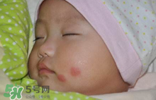 嬰兒被蚊子咬了如何去紅點(diǎn)？被蚊子咬后紅點(diǎn)如何去除？