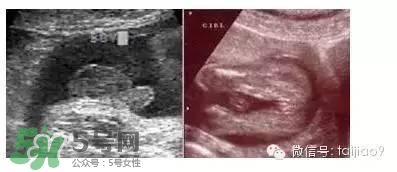 B超單數(shù)據(jù)怎么看男女？B超單看男女準(zhǔn)嗎？