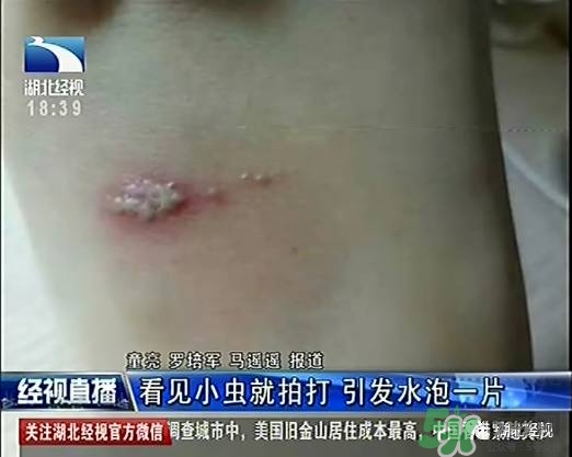隱翅蟲有毒嗎？隱翅蟲會(huì)毀容嗎？