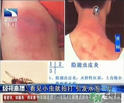 隱翅蟲有毒嗎？隱翅蟲會(huì)毀容嗎？