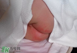 尿布疹怎么辦？寶寶尿布疹擦什么藥好？