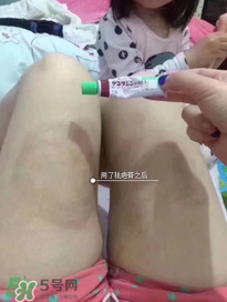 日本msd祛疤膏怎么樣？日本msd祛疤膏有用嗎？