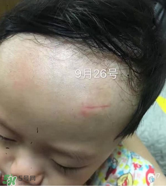日本msd祛疤膏是抗生素嗎？日本msd祛疤膏是不是抗生素？