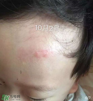 日本msd祛疤膏是抗生素嗎？日本msd祛疤膏是不是抗生素？