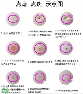 藥水點(diǎn)痣和激光點(diǎn)痣哪個(gè)好？各有什么優(yōu)缺點(diǎn)