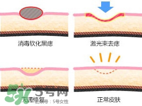 藥水點(diǎn)痣和激光點(diǎn)痣哪個(gè)好？各有什么優(yōu)缺點(diǎn)
