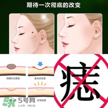 藥水點(diǎn)痣和激光點(diǎn)痣哪個(gè)好？各有什么優(yōu)缺點(diǎn)