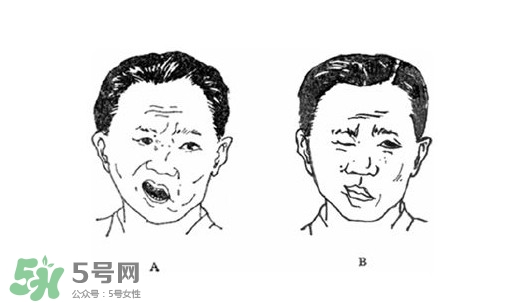 面癱是什么導(dǎo)致的？面癱多久徹底恢復(fù)正常