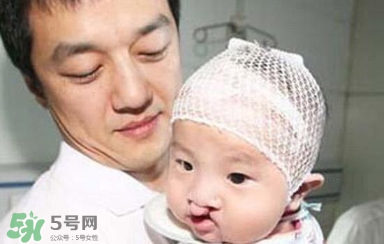 兔唇是什么？兔唇是什么原因造成的？