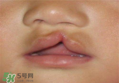兔唇能檢查出來嗎？兔唇能完全修復(fù)嗎？