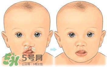 兔唇能檢查出來嗎？兔唇能完全修復(fù)嗎？