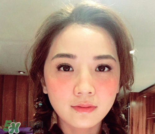夏天可以點(diǎn)痣嗎？夏天點(diǎn)痣后要注意什么？