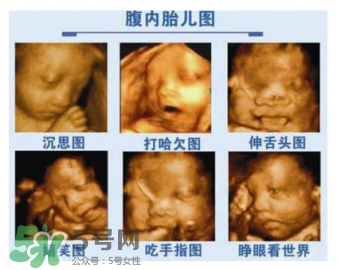四維彩超有必要做嗎？四維彩超檢查不出什么？