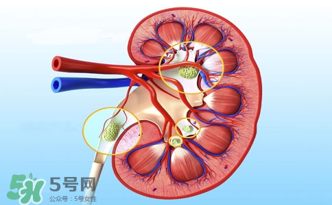 腎結(jié)石有什么癥狀？腎結(jié)石原因