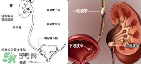 腎結石怎么治最好？腎結石的醫(yī)治方法