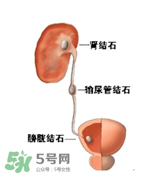 腎結(jié)石有什么癥狀？腎結(jié)石原因
