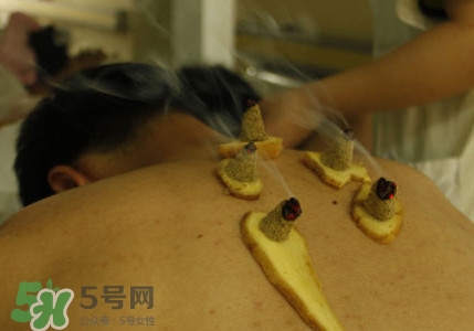 三伏灸有用嗎？2017年三伏艾灸時間
