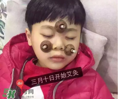 艾灸貼可以治咳嗽嗎？艾灸貼可以治退燒嗎？