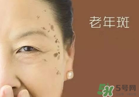 老年斑多大年齡開始有？為什么牙膏能去老年斑？