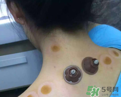 艾灸貼后有水泡怎么辦？貼艾灸貼應(yīng)注意些什么？