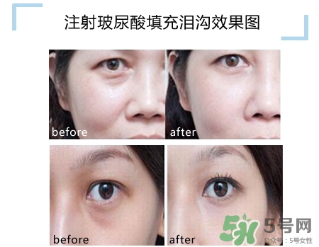 玻尿酸填充淚溝多久恢復(fù)自然？玻尿酸填充淚溝的危害