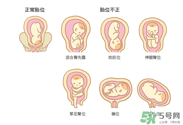 胎位不正如何矯正？胎位不正一定要剖腹產(chǎn)嗎？