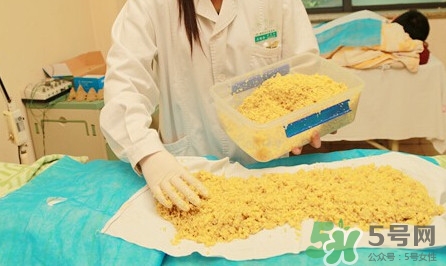 隔姜灸效果怎么樣？隔姜灸好還是直接灸好