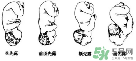 胎位不正能順產(chǎn)嗎？胎位不正怎么辦？