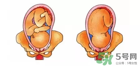 胎位不正能順產(chǎn)嗎？胎位不正怎么辦？