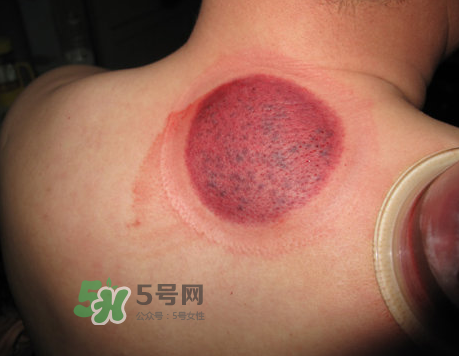 三伏天拔罐后多久可以洗澡？三伏天拔罐后注意事項(xiàng)